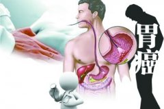 胃癌最震惊世人的早期信号